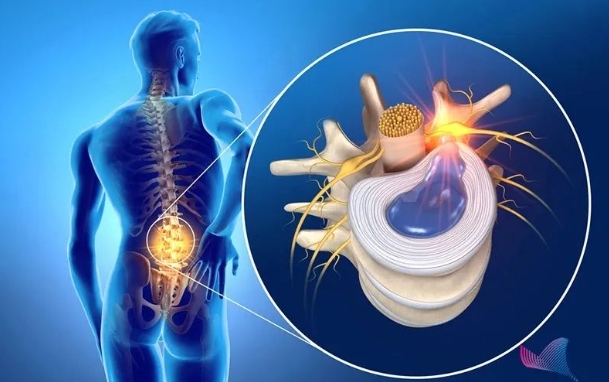 【合肥长淮中医医院】腰间盘突出需要手术吗？